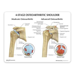 GPI Anatomicals Shoulder Joint Model Set | Human Body Anatomy Replica Set of 4-Stage Osteoarthritis Shoulder Joint for Doctors Office Educational Tool