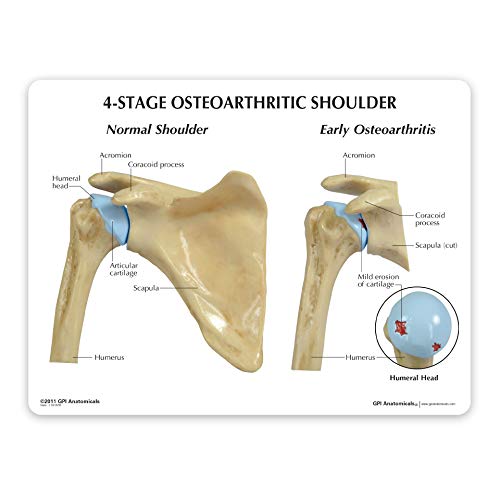 GPI Anatomicals Shoulder Joint Model Set | Human Body Anatomy Replica Set of 4-Stage Osteoarthritis Shoulder Joint for Doctors Office Educational Tool