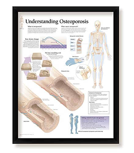 Set of 3 Framed Medical Posters Osteoarthritis Rheumatoid Arthritis Understanding Osteoporosis 22"x28" Wall Diagrams Educational Informational Doctors Office Rheumatology Charts