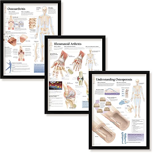 Set of 3 Framed Medical Posters Osteoarthritis Rheumatoid Arthritis Understanding Osteoporosis 22"x28" Wall Diagrams Educational Informational Doctors Office Rheumatology Charts