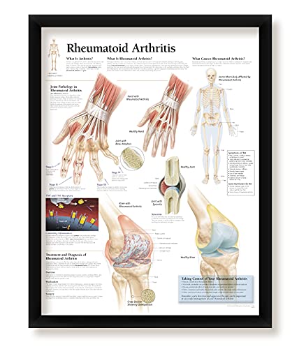 Set of 3 Framed Medical Posters Osteoarthritis Rheumatoid Arthritis Understanding Osteoporosis 22"x28" Wall Diagrams Educational Informational Doctors Office Rheumatology Charts