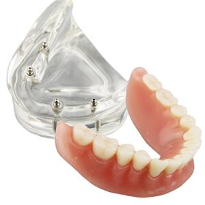 smile1000 dental model overdenture inferior 4 implants demo for teaching and studying