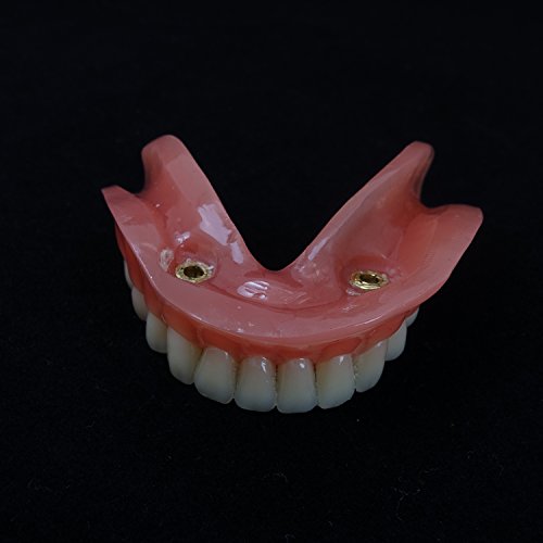 Smile1000 Dental Model Overdenture Inferior 2 Implants Demo for Studing and Teaching