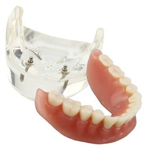 smile1000 dental model overdenture inferior 2 implants demo for studing and teaching