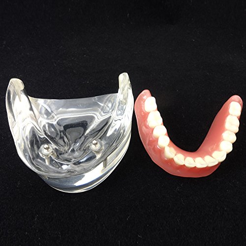 Smile1000 Dental Model Overdenture Inferior 2 Implants Demo for Studing and Teaching