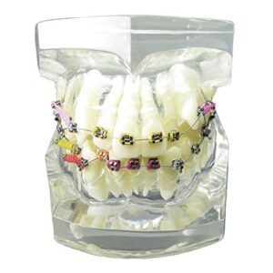 smile1000 dental malocclusion orthodontic treatment teeth model with metal brackets wires colorful ties chains and hoops m3005
