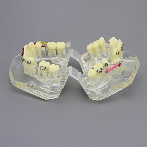 Smile1000 Dental Malocclusion Orthodontic Treatment Teeth Model with Metal Brackets Wires Colorful Ties Chains and Hoops M3005