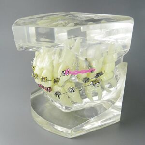 Smile1000 Dental Malocclusion Orthodontic Treatment Teeth Model with Metal Brackets Wires Colorful Ties Chains and Hoops M3005