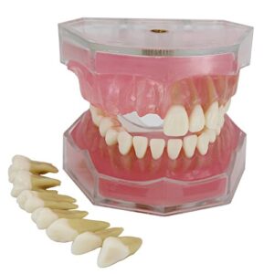 dental implant teeth model study teach standard model with removable teeth