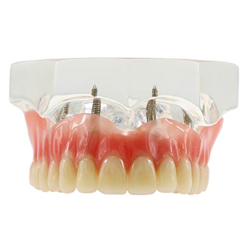 DENTALMALL Dental Upper Implants Model Overdenture with 4 Superior Teeth Demo Transparent Vision for Education and Study Model Tool M6001 C