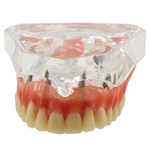 DENTALMALL Dental Upper Implants Model Overdenture with 4 Superior Teeth Demo Transparent Vision for Education and Study Model Tool M6001 C