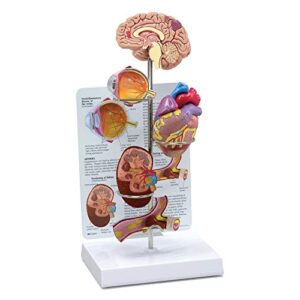 gpi anatomicals - hypertension model set | human body anatomy replica of the effects from high blood pressure for doctors office educational tool