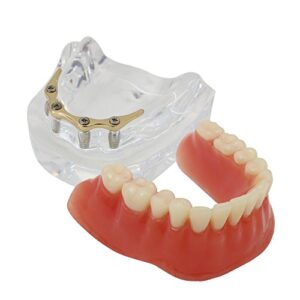 dental teeth model precision 4 implant overdenture inferior tooth golden color