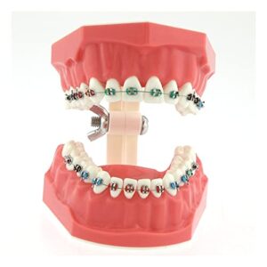 Dentalmall Typodonts Orthodontics Demonstration Model with Metal Wires and Bracket Teaching, Learning, Interpretation Model for Adults and Children (Metal Bracket)