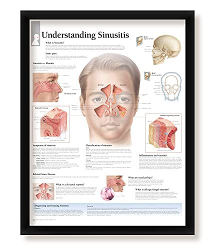 Set of 4 Framed Medical Posters Ear, Nose and Throat, Understanding Sinusitis, Understanding Rhinitis, and Middle Ear Infections 22"x28" Wall Diagrams