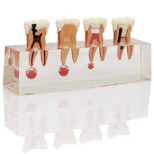 dentalmall dental 4-stage endodontic treatment model for study teach teeth model 4018 root canal anatomy demonstration teaching tooth model