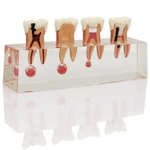 Dentalmall Dental 4-Stage Endodontic Treatment Model for Study Teach Teeth Model 4018 Root Canal Anatomy Demonstration Teaching Tooth Model