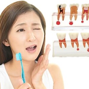 Dentalmall Dental 4-Stage Endodontic Treatment Model for Study Teach Teeth Model 4018 Root Canal Anatomy Demonstration Teaching Tooth Model