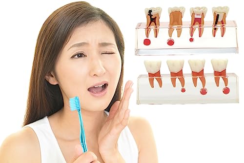 Dentalmall Dental 4-Stage Endodontic Treatment Model for Study Teach Teeth Model 4018 Root Canal Anatomy Demonstration Teaching Tooth Model