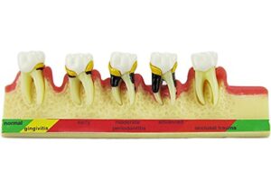 dental periodontal disease assort tooth teeth typodont study teaching model new