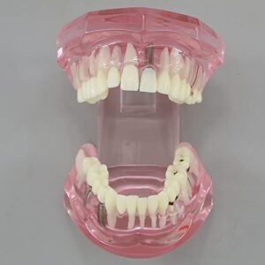 Dentalmall Teeth Model Teeth Typodonts Dental Implant Study Analysis Demonstration Teeth Model #2001 with Restoration Pink