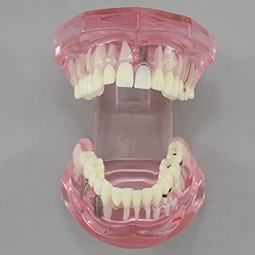 Dentalmall Teeth Model Teeth Typodonts Dental Implant Study Analysis Demonstration Teeth Model #2001 with Restoration Pink