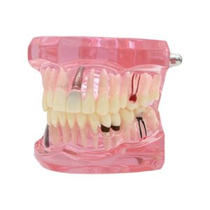 dentalmall teeth model teeth typodonts dental implant study analysis demonstration teeth model #2001 with restoration pink