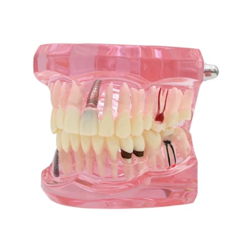 Dentalmall Teeth Model Teeth Typodonts Dental Implant Study Analysis Demonstration Teeth Model #2001 with Restoration Pink