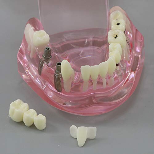 Dentalmall Teeth Model Teeth Typodonts Dental Implant Study Analysis Demonstration Teeth Model #2001 with Restoration Pink