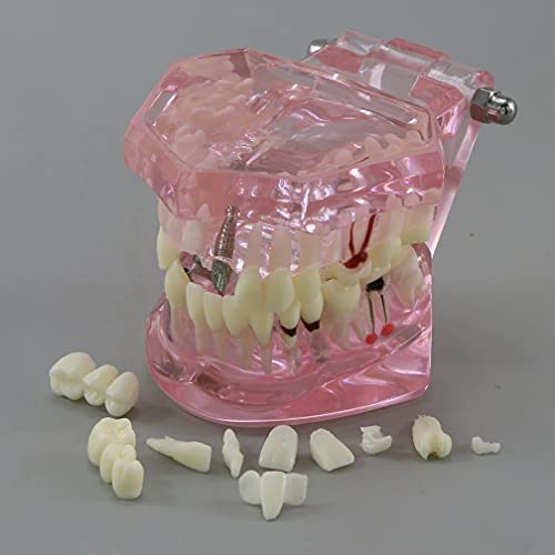 Dentalmall Teeth Model Teeth Typodonts Dental Implant Study Analysis Demonstration Teeth Model #2001 with Restoration Pink