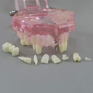 Dentalmall Teeth Model Teeth Typodonts Dental Implant Study Analysis Demonstration Teeth Model #2001 with Restoration Pink