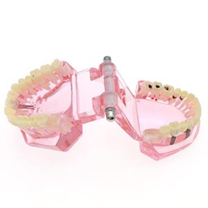 Dentalmall Teeth Model Teeth Typodonts Dental Implant Study Analysis Demonstration Teeth Model #2001 with Restoration Pink