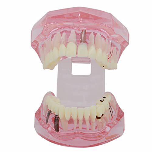 Dentalmall Teeth Model Teeth Typodonts Dental Implant Study Analysis Demonstration Teeth Model #2001 with Restoration Pink