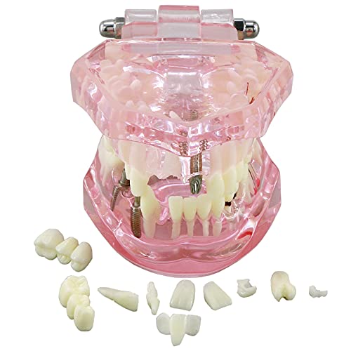 Dentalmall Teeth Model Teeth Typodonts Dental Implant Study Analysis Demonstration Teeth Model #2001 with Restoration Pink