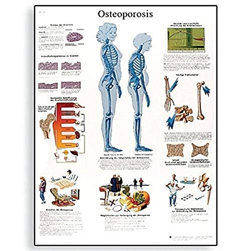 3B Scientific VR1121UU Glossy Paper Osteoporosis Anatomical Chart, Poster Size 20" Width x 26" Height