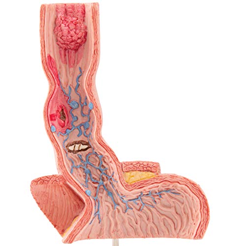 3B Scientific K18 Illnesses of the Esophagus - 3B Smart Anatomy