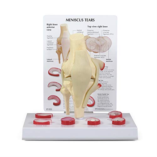 GPI Anatomicals - Human Anatomy Model of Knee Joint with Meniscus Tears, Replica for Anatomy and Physiology Education, Anatomy Model for Doctor's Office and Classrooms, Medical Study Supplies