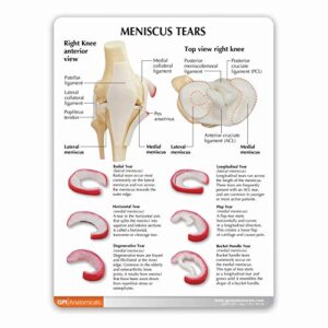 GPI Anatomicals - Human Anatomy Model of Knee Joint with Meniscus Tears, Replica for Anatomy and Physiology Education, Anatomy Model for Doctor's Office and Classrooms, Medical Study Supplies