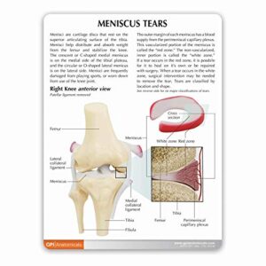 GPI Anatomicals - Human Anatomy Model of Knee Joint with Meniscus Tears, Replica for Anatomy and Physiology Education, Anatomy Model for Doctor's Office and Classrooms, Medical Study Supplies