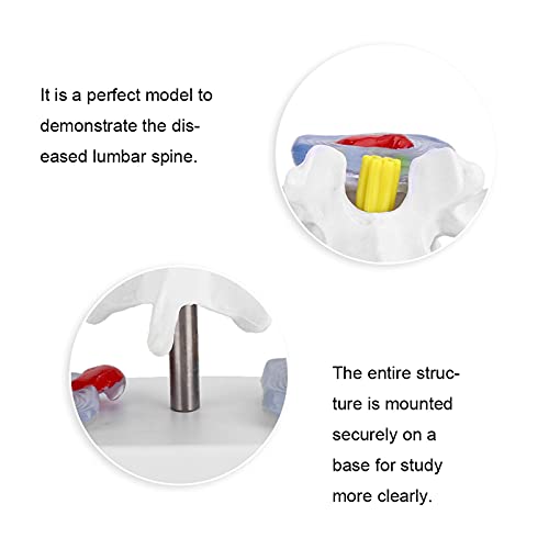 Wene Human Spine Model, Professional Vivid Lumbar Model Clearly Study with 2 Diseased Intervertebral Discs for School