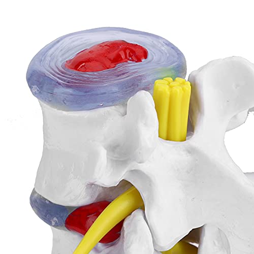 Wene Human Spine Model, Professional Vivid Lumbar Model Clearly Study with 2 Diseased Intervertebral Discs for School