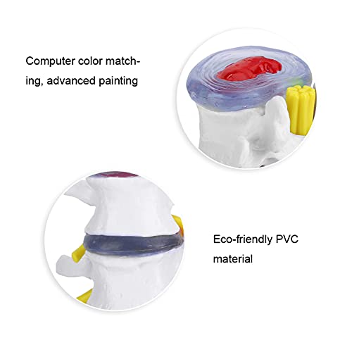 Wene Human Spine Model, Professional Vivid Lumbar Model Clearly Study with 2 Diseased Intervertebral Discs for School