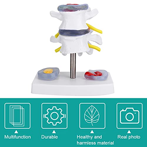 Wene Human Spine Model, Professional Vivid Lumbar Model Clearly Study with 2 Diseased Intervertebral Discs for School