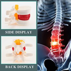 RONTEN Lumbar Disc Herniated Model, Human Anatomical Lumbar Spine Model for Medical Teaching & Learning