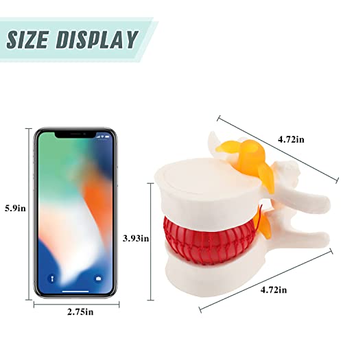 RONTEN Lumbar Disc Herniated Model, Human Anatomical Lumbar Spine Model for Medical Teaching & Learning
