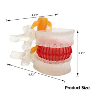 MIIRR Human Lumbar Disc Herniation Model, Transparent Medical Model of Vertebral Spine Anatomy with Elastic Software, Perfect for Learning and Teaching Tool