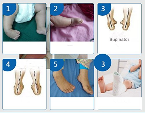 Kids AFO Drop Foot Splint Baby Ankle Foot Brace Night Splint Toddler Strephenopodia Strephexopodia Splint (20cm)