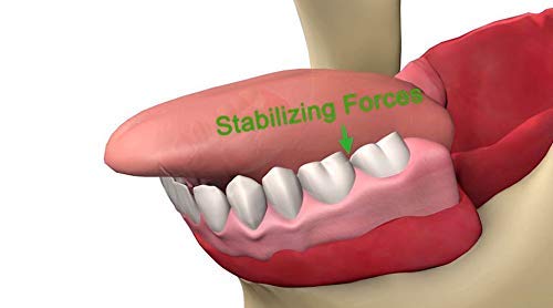 Lower Denture Stabilizers