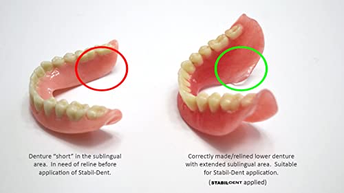 Lower Denture Stabilizers