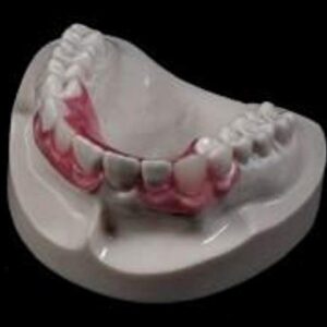 "Nesbit bridge" , Flipper Uppler and Lower Set of Affordability Flexible Valplast Customized Partial Denture (Pink, Valplast)